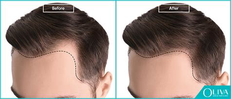 5 inches above your highest wrinkle. . How to grow temple hair back reddit